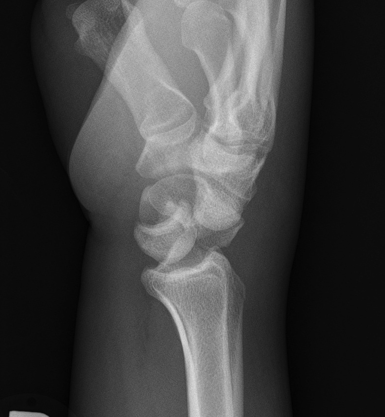 Transscaphoid Perilunate Dislocation Lateral